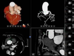 冠脈功能影像分析系統qfr-a