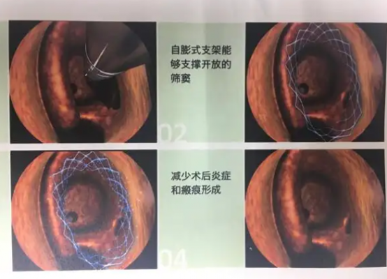 全降解鼻竇藥物支架系統sdes4212-1浦易