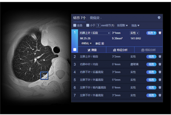 肺結(jié)節(jié)ct圖像輔助檢測(cè)軟件ai-rad companion西門子