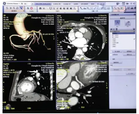 冠脈ct造影圖像血管狹窄輔助評(píng)估軟件inferread cta coronary