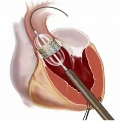 經(jīng)導管主動脈瓣系統(tǒng)fg17000-av23